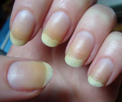 Share 72+ nail polish discoloration best